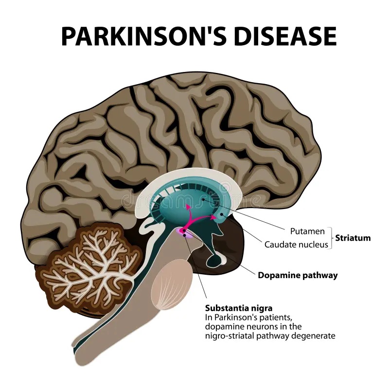 evidence oral bacteria can trigger&nbsp;Parkinson’s